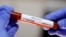 Epruveta sa testom na koronavirus