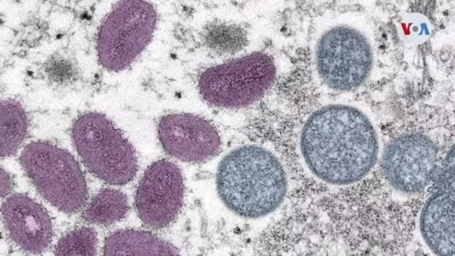 Área de Los Ángeles ve alza en casos de viruela símica por transmisión comunitaria