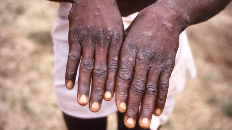 WHO Considers Declaring Monkeypox a Global Health Emergency