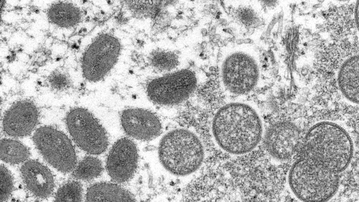 Monkeypox virus may become established as a new sexually transmitted disease in the United States