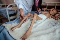 Seorang anak laki-laki kekurangan gizi terbaring di ranjang rumah sakit di Pusat Kesehatan Aslam, Hajjah, Yaman. (Foto: AP)
