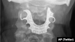 تصویر اشعه ایکس از دندان مصنوعی که در گلوی یک مرد سالمند بریتانیایی گیر کرده بود