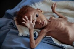 FILE - A severely malnourished boy rests on a hospital bed at the Aslam Health Center, Hajjah, Yemen, Oct. 1, 2018.