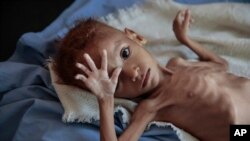 FILE - A severely malnourished boy rests on a hospital bed at the Aslam Health Center, Hajjah, Yemen, Oct. 1, 2018.