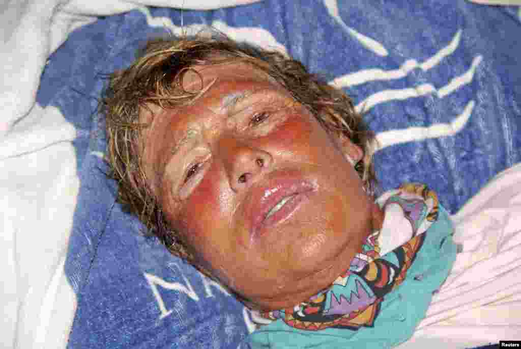 Diana Nyad descansa luego de haber sido sacada del agua por su equipo. Tan solo la noche del lunes sufrió de nueve picaduras de medusas.