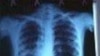 Mining Driving TB Epidemic in Sub-Saharan Africa