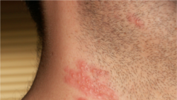 ေရယုန္ႀကီး ေရာဂါ (herpes-zoster-or-shingles)