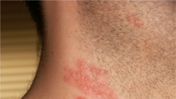 ရေယုန်ကြီး ရောဂါ (herpes-zoster-or-shingles)