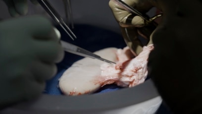 Experiment Puts Pig’s Kidney in Brain-dead Human Body