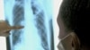 Hỏi đáp Y học: Nghẽn phổi mãn tính