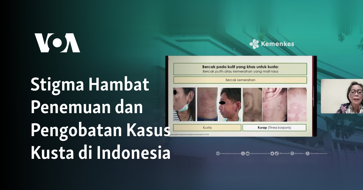 Stigma Hambat Penemuan dan Pengobatan Kasus Kusta di Indonesia