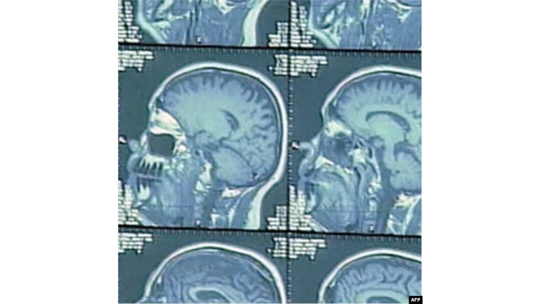 U slučaju pojave Alchajmera ili demencije, mozak ljudi koji poznaju više jezika bolje funkcioniše od onih koji govore samo jednim