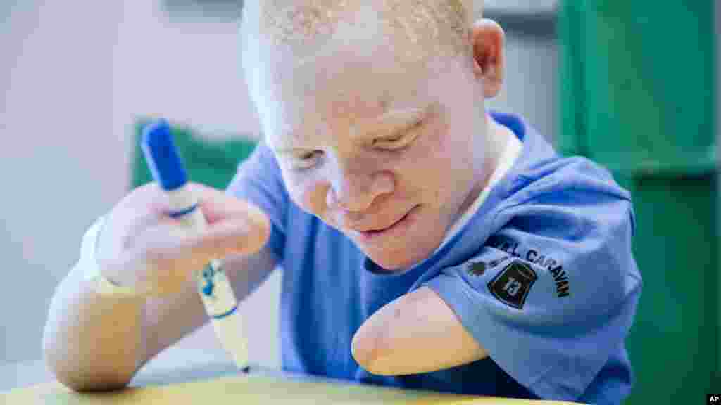 Albino Children Prosthetics