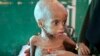 Somali Children Dying of Starvation - UNICEF