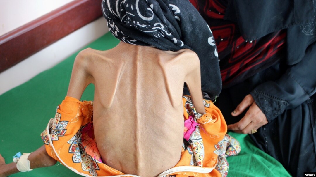 Fatima yang berusia 12 tahun hanya memiliki berat 10kg ketika dibawa ke klinik.