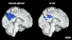 Alzheimer's researchers switch focus to prevention.