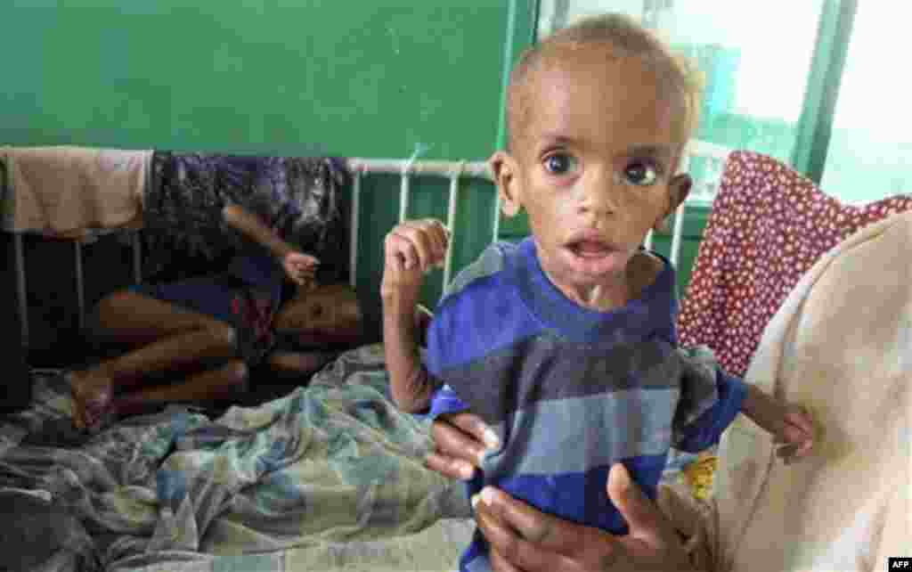 A child from southern Somalia, is treated for malnourishment in Banadir hospital in Mogadishu, Somalia, Friday, Aug. 5, 2011. The United Nations predicts famine will probably spread to all of southern Somalia within a month and force tens of thousands mo