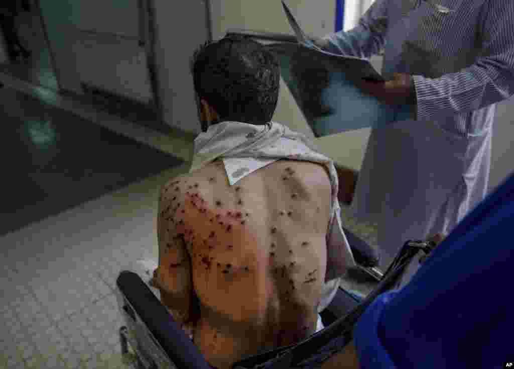 A Kashmiri man with his pellet ridden back sits on wheelchair at a hospital after he was injured in clashes in Srinagar, Indian-controlled Kashmir.
