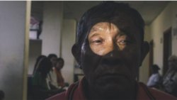 ျမန္မာႏုိင္ငံက မ်က္ခမ္းစပ္ေရာဂါကုိ ေအာင္ျမင္စြာထိန္းႏုိင္ၿပီ (WHO)