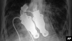 An X-ray shows a continuous-flow artificial heart