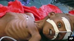 A malnourished child from southern Somalia lies in Banadir hospital in Mogadishu, July 13, 2011