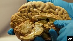 A researcher holds a human brain (file photo)
