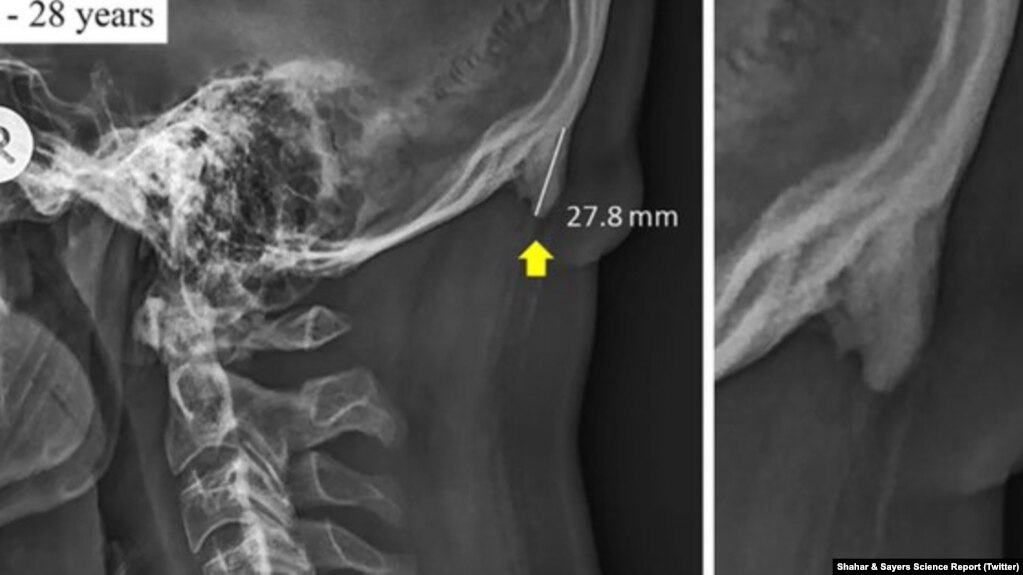 برجستگی عجیب شاخ مانند به طول نزدیک به ۳ سانتیمتر در پشت گردن یک جوان ۲۸ ساله - عکس اشعه ایکس از پژوهشگران «دیوید شخر» و «مارک سایر» 