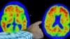 Researchers Return to Alzheimer's Vaccines