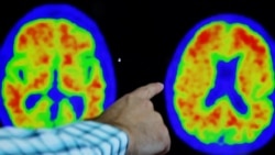 Quiz - Researchers: New Blood Tests Help Doctors Identify Alzheimer’s Disease