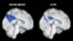 Alzheimer's Disease 
