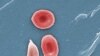 Gene-editing Treatment Shows Promise for Sickle Cell, Other Blood Disease