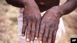 원숭이두창 환자의 피부에 나타난 증상 (자료사진) 