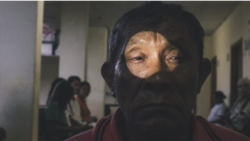 မြန်မာနိုင်ငံက မျက်ခမ်းစပ်ရောဂါကို အောင်မြင်စွာထိန်းနိုင်ပြီ (WHO)