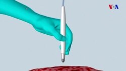 Xərçəng xəstəliyini 10 saniyəyə aşkar edən “MassSpec Pen” cihazı