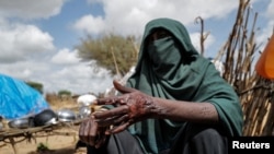 FILE - An unnamed Sudanese activist who fled the conflict in Geneina, in Sudan's Darfur region, shows her burn scars from an attack by the Rapid Support Forces (RSF) and Arab tribe on an internally displaced people camp where she lived, in Adre, Chad August 5, 2023. 