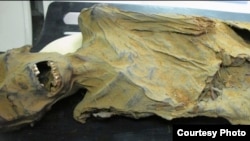 Coronary artery calcifications were found in this mummy of Ahmose Meyret Amon, an Egyptian princess who was between 40 and 45 years when she died. She lived about 1580–1550 BCE and was found near modern day Luxor. (The Lancet)