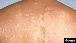 Tinea Versicolor - skin disease