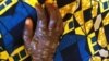 Centrafrique : épidémie de variole du singe dans l'est du pays