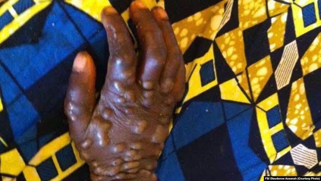 Monkey pox patient in RCA