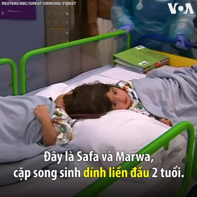 Anh: Phẫu thuật tách rời cặp song sinh dính liền đầu thành công