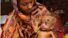 A Bangladeshi mother holds her child, who was treated for malnutrition at the International Centre for Diarrhoel Disease Research in Dhaka.(Photo by Rabiul Hasan/International Centre For Diarrhoeal Disease Research) 