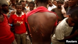An Ethiopian migrant shows torture wounds he received from traffickers as he waits to be repatriated at a transit center in the western Yemeni town of Haradh, on the border with Saudi Arabia, Mar. 16, 2012.
