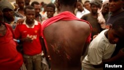 FILE - An Ethiopian migrant shows torture wounds he received from traffickers as he waits to be repatriated at a transit center in Haradh.