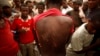 An Ethiopian migrant shows torture wounds he received from traffickers as he waits to be repatriated at a transit center in the western Yemeni town of Haradh, on the border with Saudi Arabia, Mar. 16, 2012.