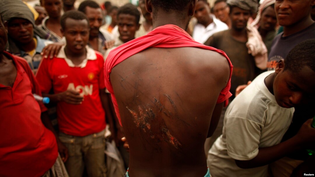 An Ethiopian migrant shows torture wounds he received from traffickers as he waits to be repatriated at a transit center in the western Yemeni town of Haradh, on the border with Saudi Arabia, Mar. 16, 2012.
