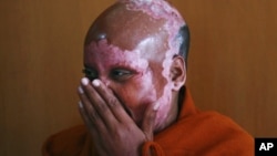 FILE - Image shows a woman, an acid attack survivor, Jan. 22, 2010.