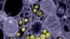 A cluster of SARS-CoV-2 (severe acute respiratory syndrome coronavirus 2) virions -- entire virus particles -- viewed through an electron microscope. (Courtesy: U.S. National Institute of Allergy and Infectious Diseases)