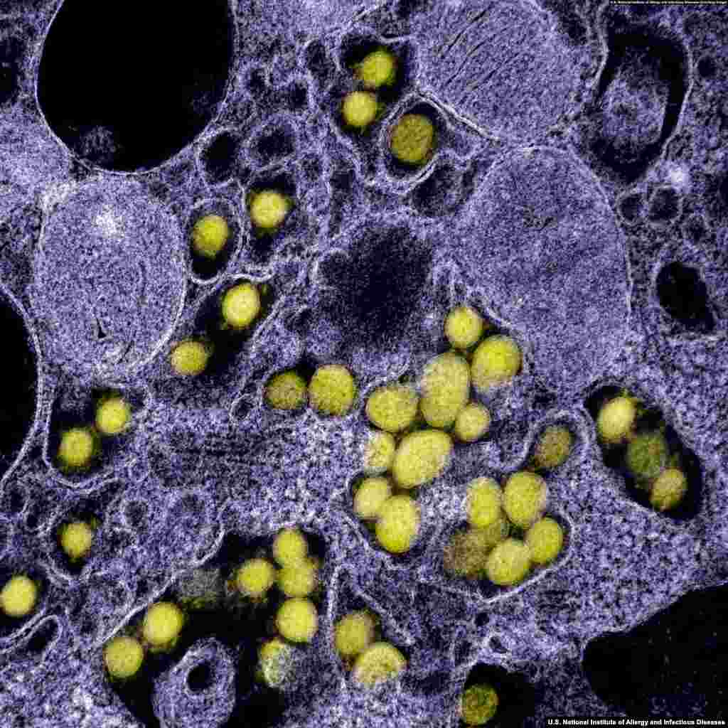 SARS-CoV-2 virions in a human cell. Medical experts advise regular handwashing and not touching one&#39;s face are the most important things to reduce the risk of contracting the virus. (Courtesy: U.S. National Institute of Allergy and Infectious Diseases)