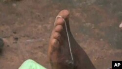 After entering the body, Guinea worm forms near the intestines and eventually burrows into connective tissue or near to joints. While often not deadly, the worm, after about a year, emerges from the body, usually in the lower limbs, causing intense pain.