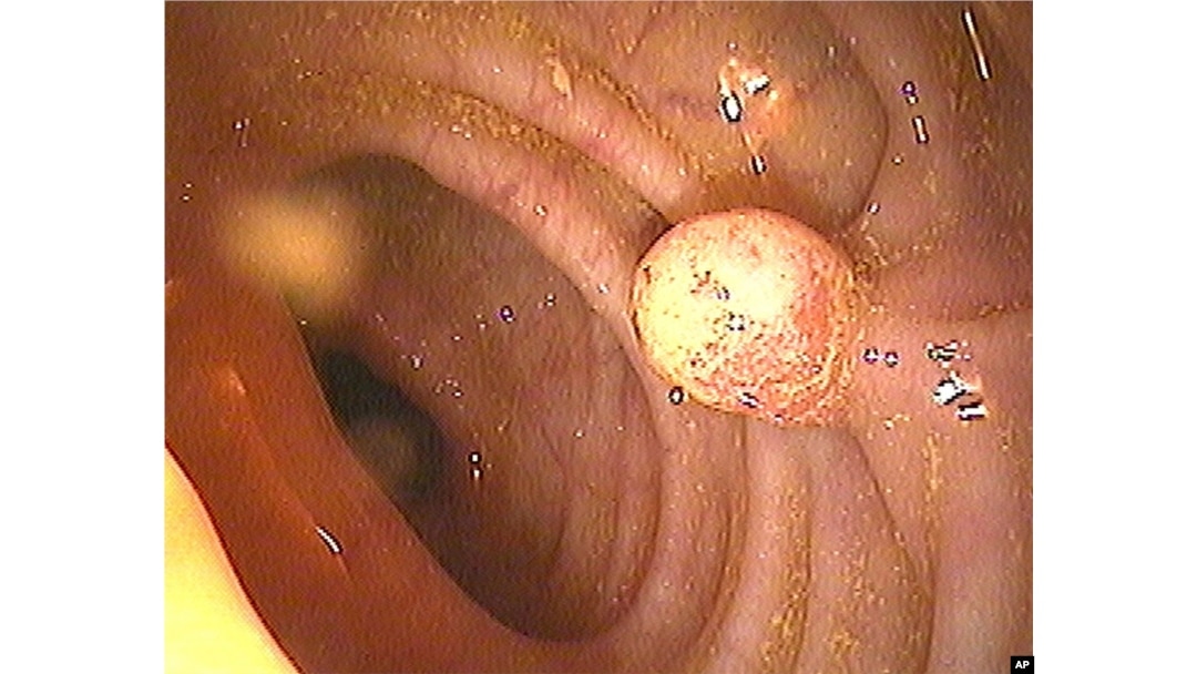 Ilustrasi - Tes kanker usus besar (Colon Cancer Test).